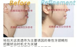 成人牙齿矫正后，反弹的可能性有多大？