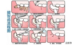 拔最后一颗智齿方法