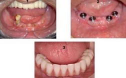 糖尿病能种牙吗