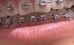 30岁矫正牙齿可以吗？成年人矫正来得及吗？