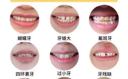 先正畸还是先贴面？顺序决定牙齿美观效果？