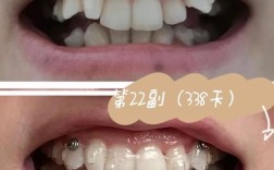 襄阳隐形牙齿矫正效果如何？适合哪些人做？