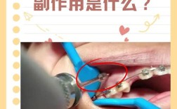 正畸 打骨钉 加钱吗