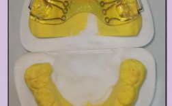 儿童牙齿活动矫正器效果如何？使用安全吗？