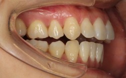 二次正畸复发概率高吗？如何科学降低复发风险？