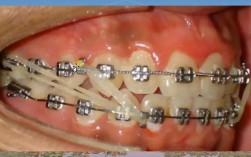 正畸牵引术后牙松动正常吗？原因及解决办法是什么？