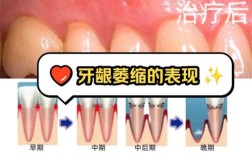 牙周炎能矫正牙齿吗？