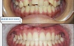 深圳牙齿矫正如何选择靠谱方法与机构？