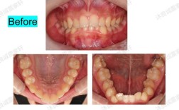 牙齿正畸扩弓真的能改变脸型吗？