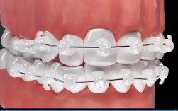 正畸托槽粘贴视频如何学？粘贴步骤技巧全掌握