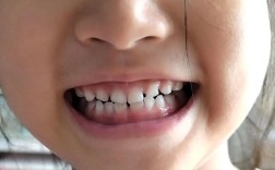 矫正一个月牙齿效果如何？变化是否正常？