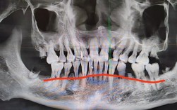正畸后牙槽吸收X光能发现什么问题？