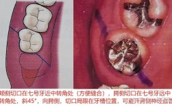 微创多生牙拔除，不同方法的选择与操作技巧是什么？