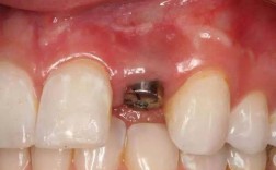 种牙会死人吗？种植牙死亡风险究竟存在吗？