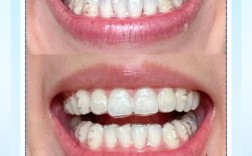 隐形矫正牙齿一般需要多久完成？