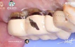 拆下烤瓷牙后，还能做正畸治疗吗？