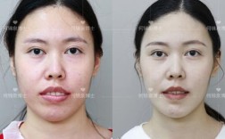 27岁矫正牙齿好不好？会不会太晚？效果会打折扣吗？