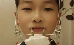 正畸前方牵引器怎么佩戴？教程步骤详解