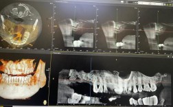 北大口腔刘玉华种牙效果如何？技术靠谱吗？