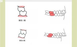 正畸 安氏三 案例