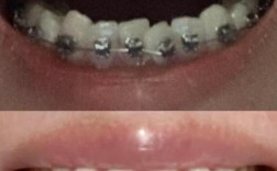 高圆圆矫正牙齿？颜值女神为变美还是健康？