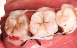 自体骨植入种牙