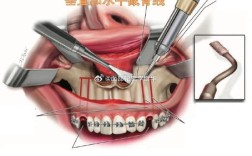 牙槽骨前突手术方法