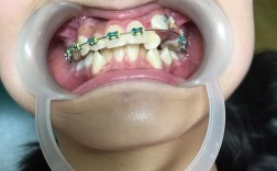 矫正牙齿做磨牙