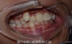 矫正牙齿进行几个月后怀孕对胎儿健康有影响吗？