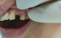 缺一颗牙能做牙齿矫正吗？效果会受影响吗？