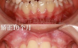 矫正牙齿牙缝合不上