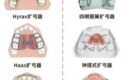 儿童正畸扩弓方法有哪些？哪种更适合孩子？