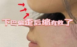 矫正牙齿后下巴歪了