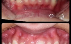 矫正后深覆盖为何出现？如何应对？