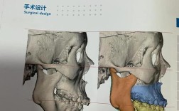口腔正畸偏额手术