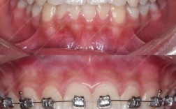 矫正牙齿选局部矫正？适用情况与效果如何？