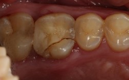 牙齿矫正后牙齿出现裂纹是何原因？