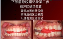 正畸保护蜡取不出来怎么办？