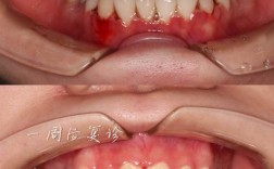 矫正牙齿长溃疡怎么办？原因与护理技巧解析