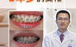 矫正牙齿最快要多久能完成？