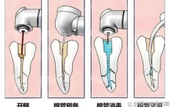 如何准确测定根管工作长度？