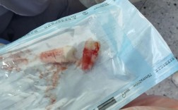 矫正牙齿拥挤一定要拔牙吗？