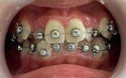 正畸矫正必须所有牙都粘托槽吗？