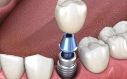 种植牙要植软组织