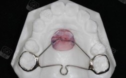 正畸nance弓属于哪种支抗类型？