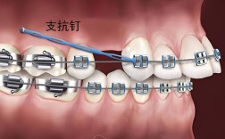 正畸支抗钉怎么取下来？过程疼吗？操作复杂吗？