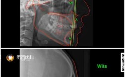 正畸软组织测量z角