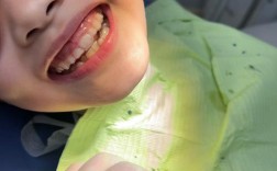 牙齿矫正下排牙齿