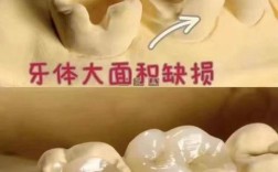 牙嵌体究竟属于哪种牙科修复体类型？与传统充填体、全冠等修复方式有何本质区别？