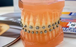 正畸治疗中PC链型号怎么选？不同品牌、材质、适应症该如何匹配才能达到最佳矫治效果？